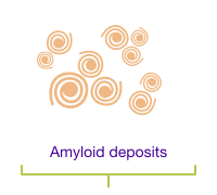 Amyloid deposits.